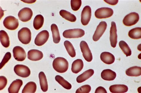 hereditary elliptocytosis life expectancy|Hereditary elliptocytosis: MedlinePlus Medical Encyclopedia.